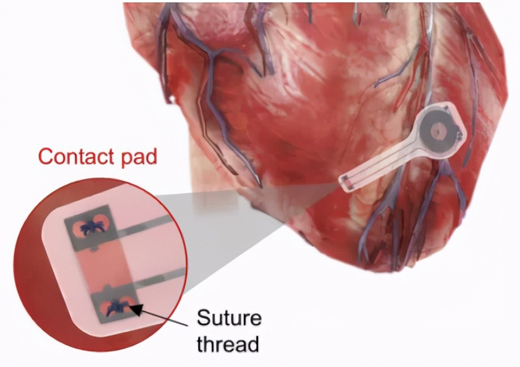 首个无线可降解临时心脏起搏器问世人体内60天完全消失